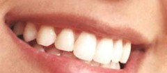 implantes-dentarios-fortaleza-1358535623